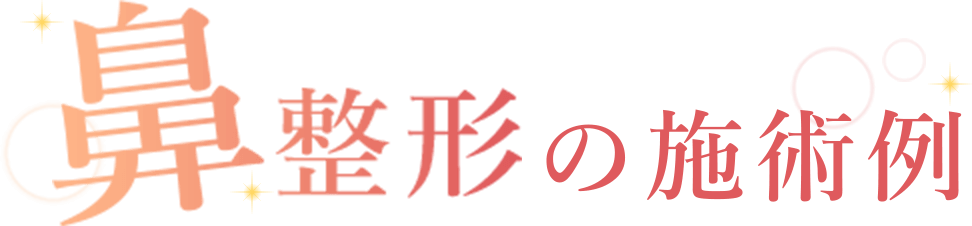 鼻整形の施術例