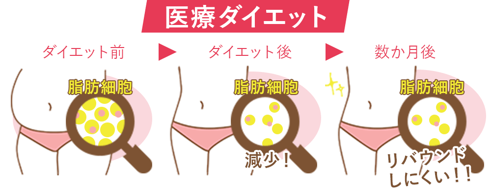 医療ダイエットの仕組み