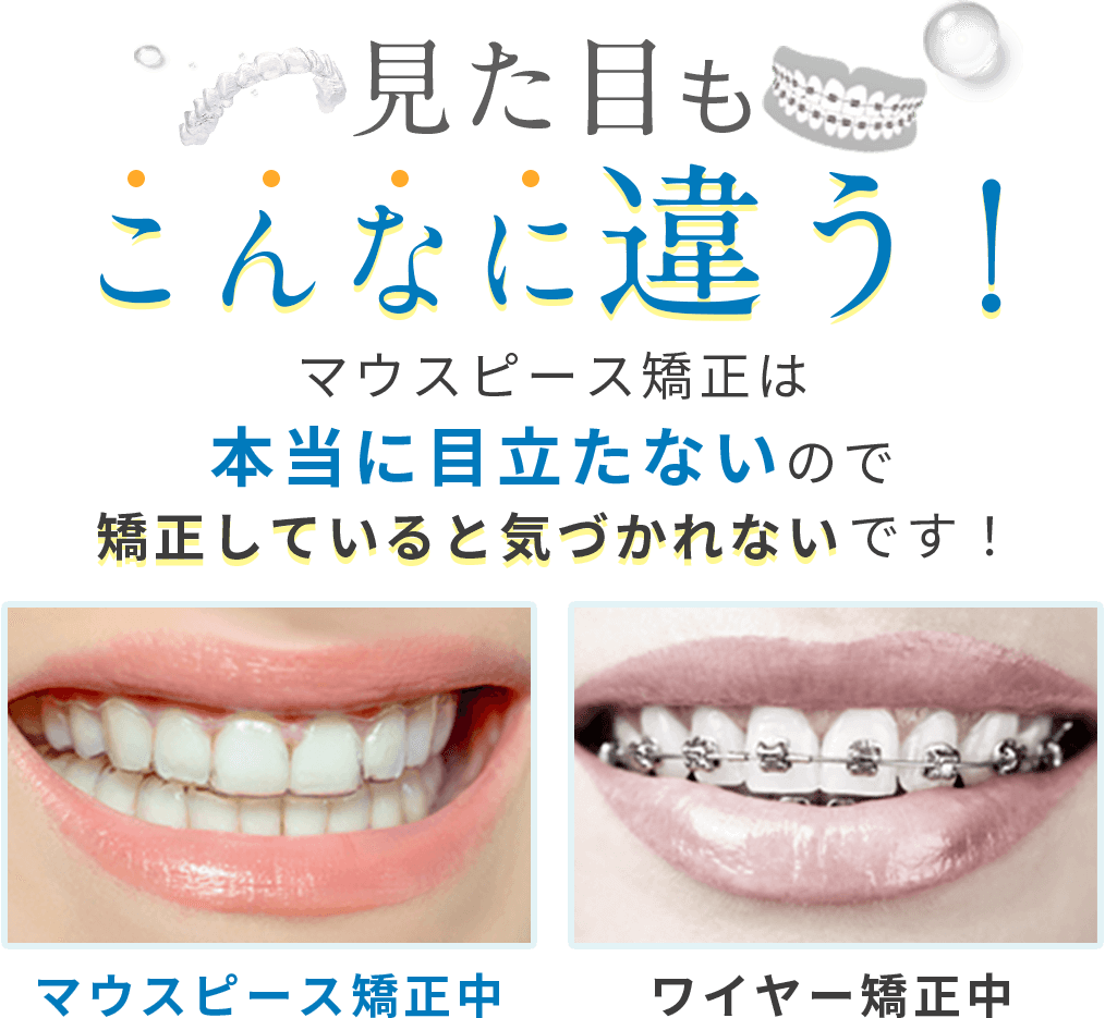 見た目もこんなに違う！マウスピース矯正は本当に目立たないので矯正していると気づかれないです！