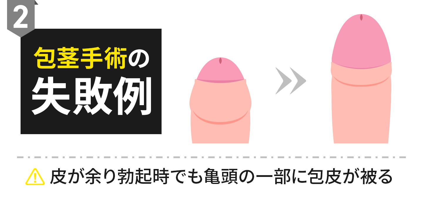 包茎手術の失敗例2：皮が余り勃起時でも亀頭の一部に包皮がかぶる