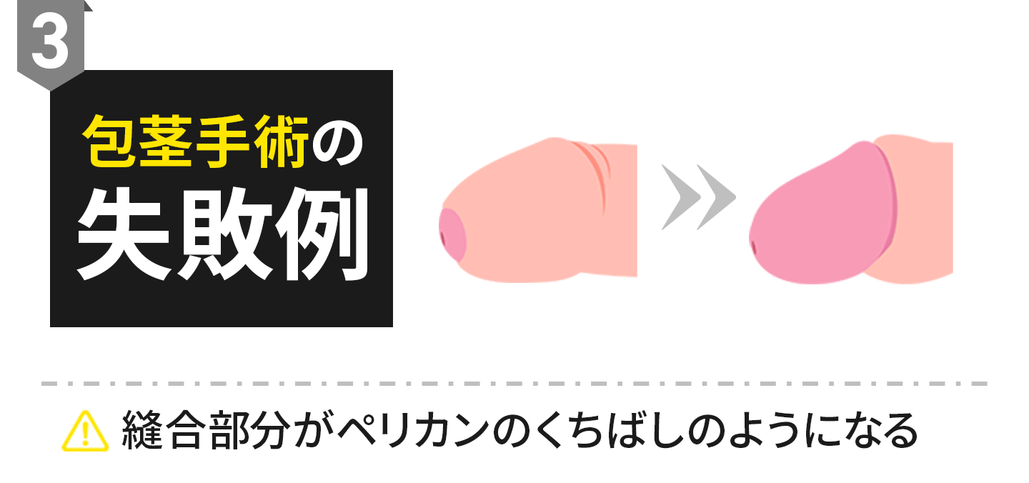 包茎手術の失敗例3：縫合部分がペリカンのくちばしのようになる