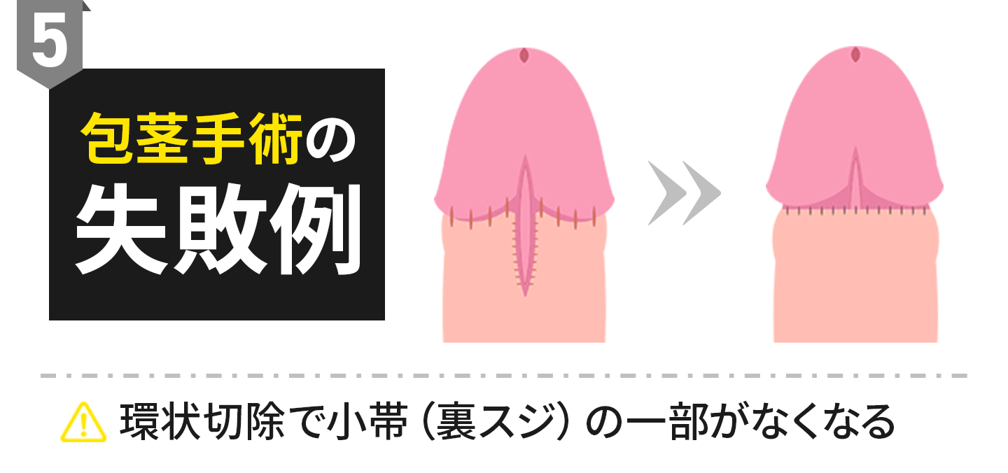包茎手術の失敗例5：環状切除で小帯（裏スジ）の一部がなくなる