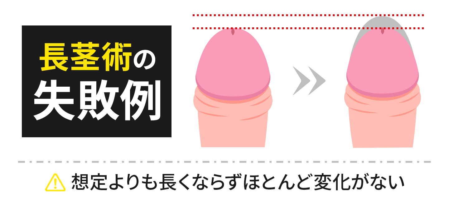 長茎術の失敗例：想定よりも長くならずほとんど変化がない
