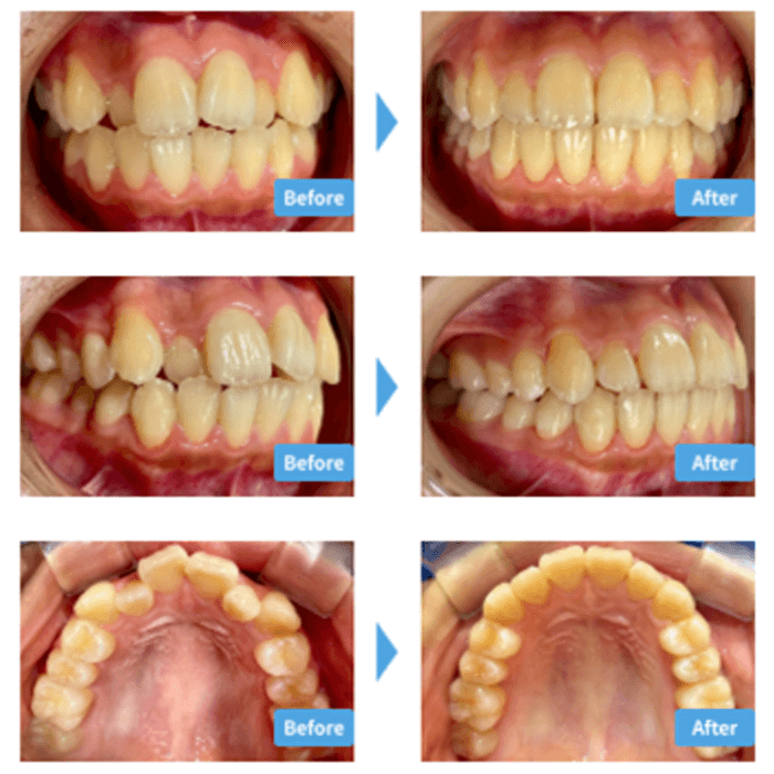 ガタガタの症例