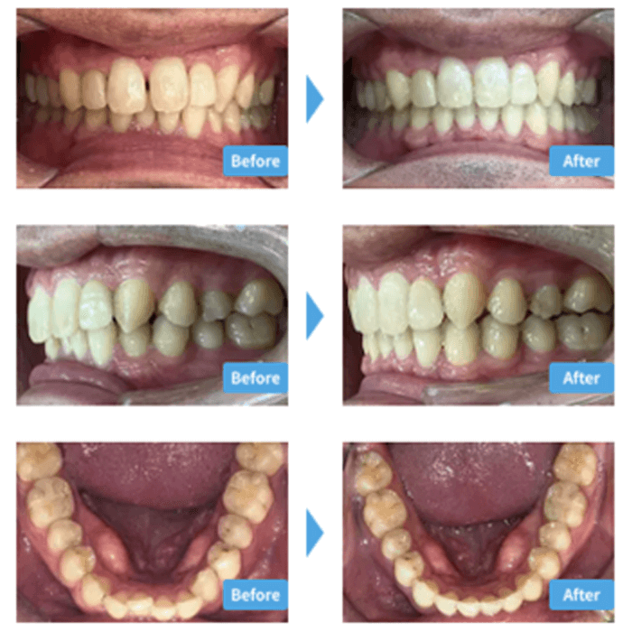 ガタガタの症例