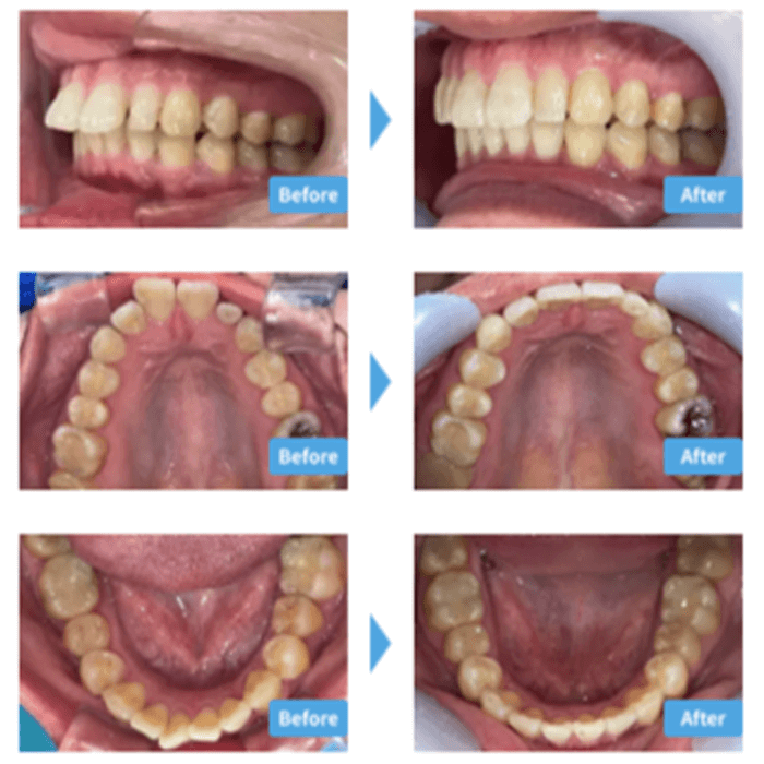ガタガタの症例