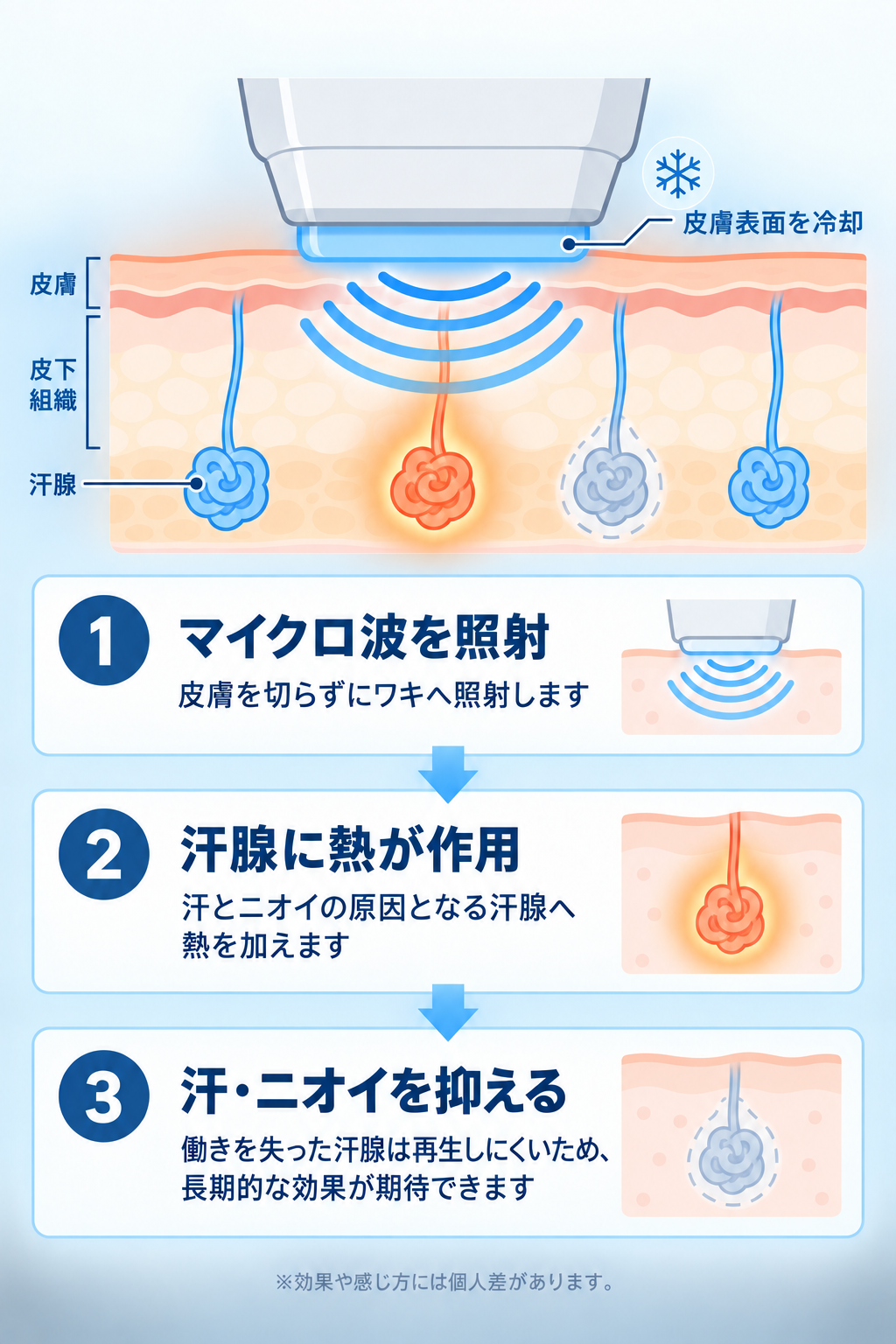 ミラドライの仕組み